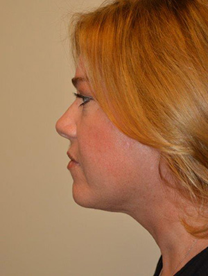 Neck Liposuction Case 5304 After Photo Neck Liposuction