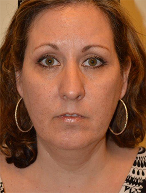 Neck Liposuction Case 5312 Before Photo Neck Liposuction