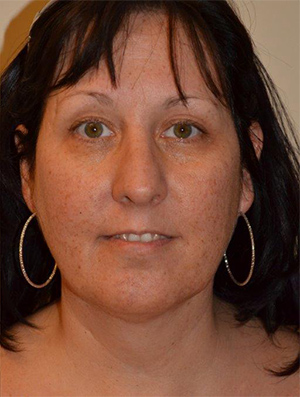 Neck Liposuction Case 5312 After Photo Neck Liposuction