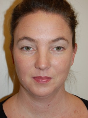 Neck Liposuction Case 5328 Before Photo Neck Liposuction