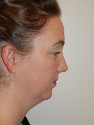 Neck Liposuction Case 5328 Before Photo Neck Liposuction