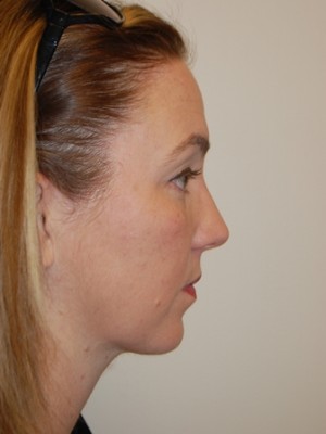 Neck Liposuction Case 5328 After Photo Neck Liposuction