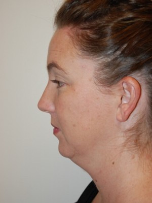 Neck Liposuction Case 5328 Before Photo Neck Liposuction