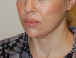 Neck Liposuction Case 5338 Before Photo Neck Liposuction