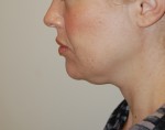 Neck Liposuction