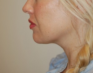 Neck Liposuction Case 5338 After Photo Neck Liposuction
