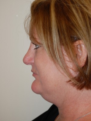 Neck Liposuction