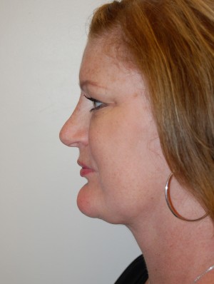 Neck Liposuction