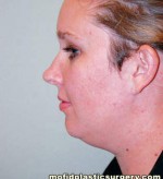 Neck Liposuction