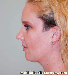 Neck Liposuction Case 5352 After Photo Neck Liposuction