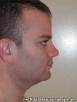 Neck Liposuction