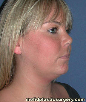 Neck Liposuction Case 5368 Before Photo Neck Liposuction