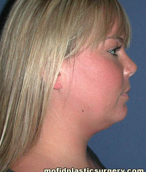 Neck Liposuction Case 5368 Before Photo Neck Liposuction