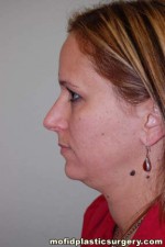 Neck Liposuction