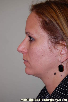 Neck Liposuction