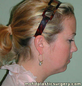 Neck Liposuction Case 5380 Before Photo Neck Liposuction