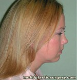 Neck Liposuction