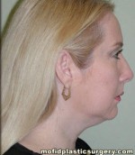 Neck Liposuction