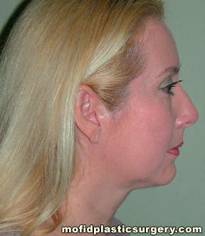 Neck Liposuction Case 5386 After Photo Neck Liposuction