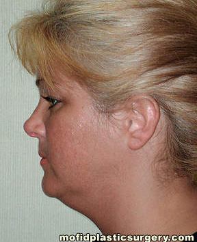 Neck Liposuction