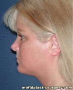 Neck Liposuction