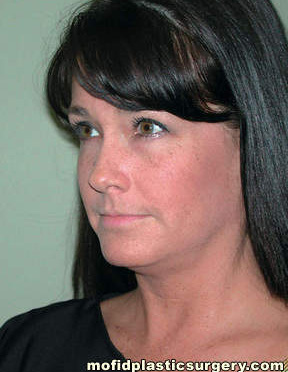 Neck Liposuction Case 5396 Before Photo Neck Liposuction
