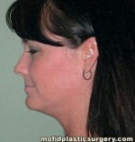 Neck Liposuction