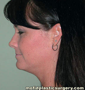 Neck Liposuction Case 5396 Before Photo Neck Liposuction