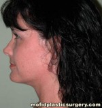 Neck Liposuction