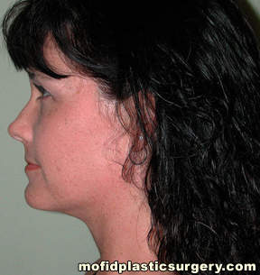 Neck Liposuction Case 5396 After Photo Neck Liposuction