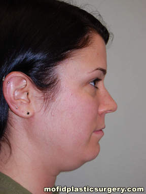 Neck Liposuction Case 5402 Before Photo Neck Liposuction