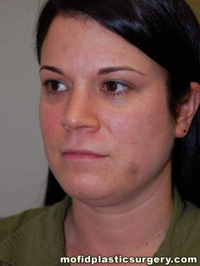 Neck Liposuction Case 5402 Before Photo Neck Liposuction