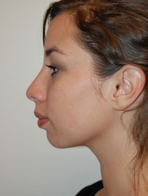 Neck Liposuction Case 5412 After Photo Neck Liposuction