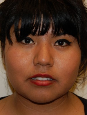 Neck Liposuction Case 5420 After Photo Neck Liposuction