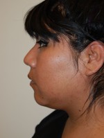 Neck Liposuction