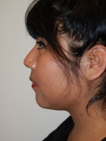 Neck Liposuction