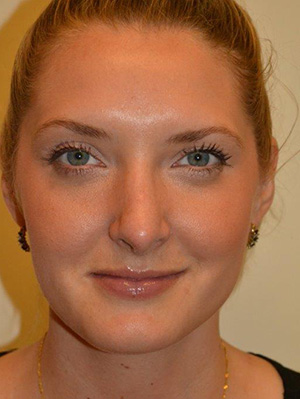 Nose Surgery Case 5433 After Photo Nose Surgery