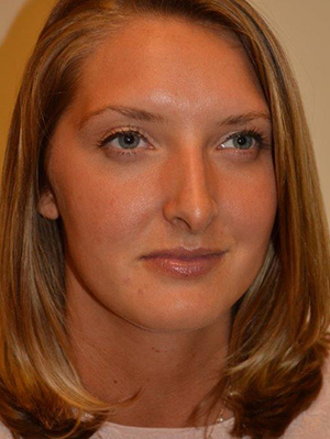 Nose Surgery Case 5433 Before Photo Nose Surgery