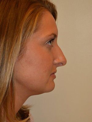 Nose Surgery Case 5433 Before Photo Nose Surgery