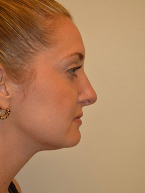 Nose Surgery Case 5433 After Photo Nose Surgery