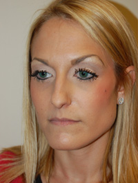 Nose Surgery Case 5492 Before Photo Nose Surgery
