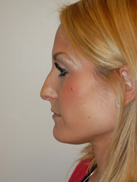 Nose Surgery Case 5492 Before Photo Nose Surgery