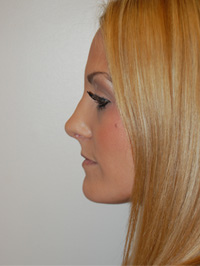 Nose Surgery Case 5492 After Photo Nose Surgery