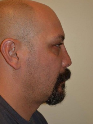 Nose Surgery Case 5524 After Photo Nose Surgery