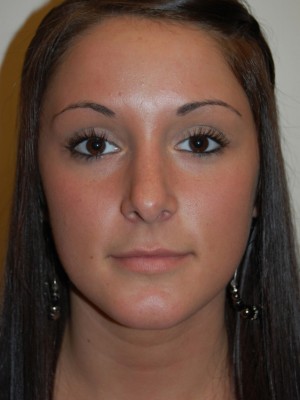 Nose Surgery Case 5544 After Photo Nose Surgery