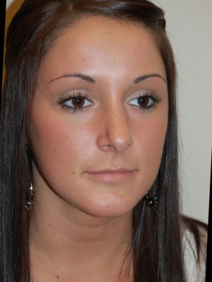 Nose Surgery Case 5544 After Photo Nose Surgery