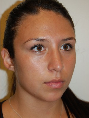 Nose Surgery Case 5593 After Photo Nose Surgery
