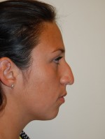 Nose Surgery