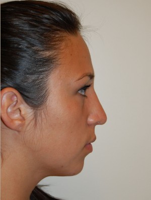 Nose Surgery Case 5593 After Photo Nose Surgery