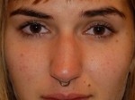 Nose Surgery